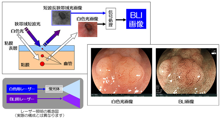 BLI（Blue LASER Imaging）